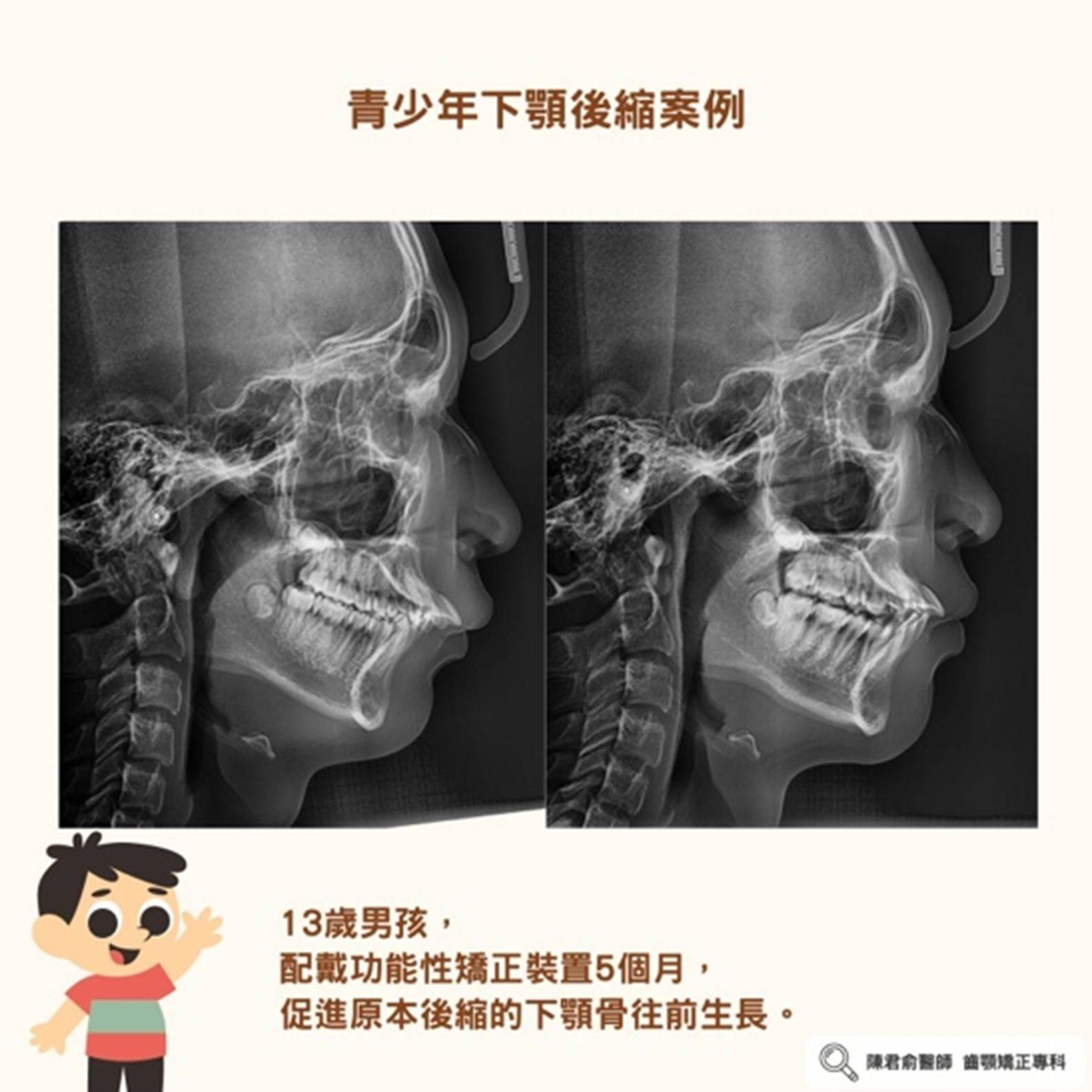 《青春期下顎後縮案例》 《青春期下顎後縮案例》