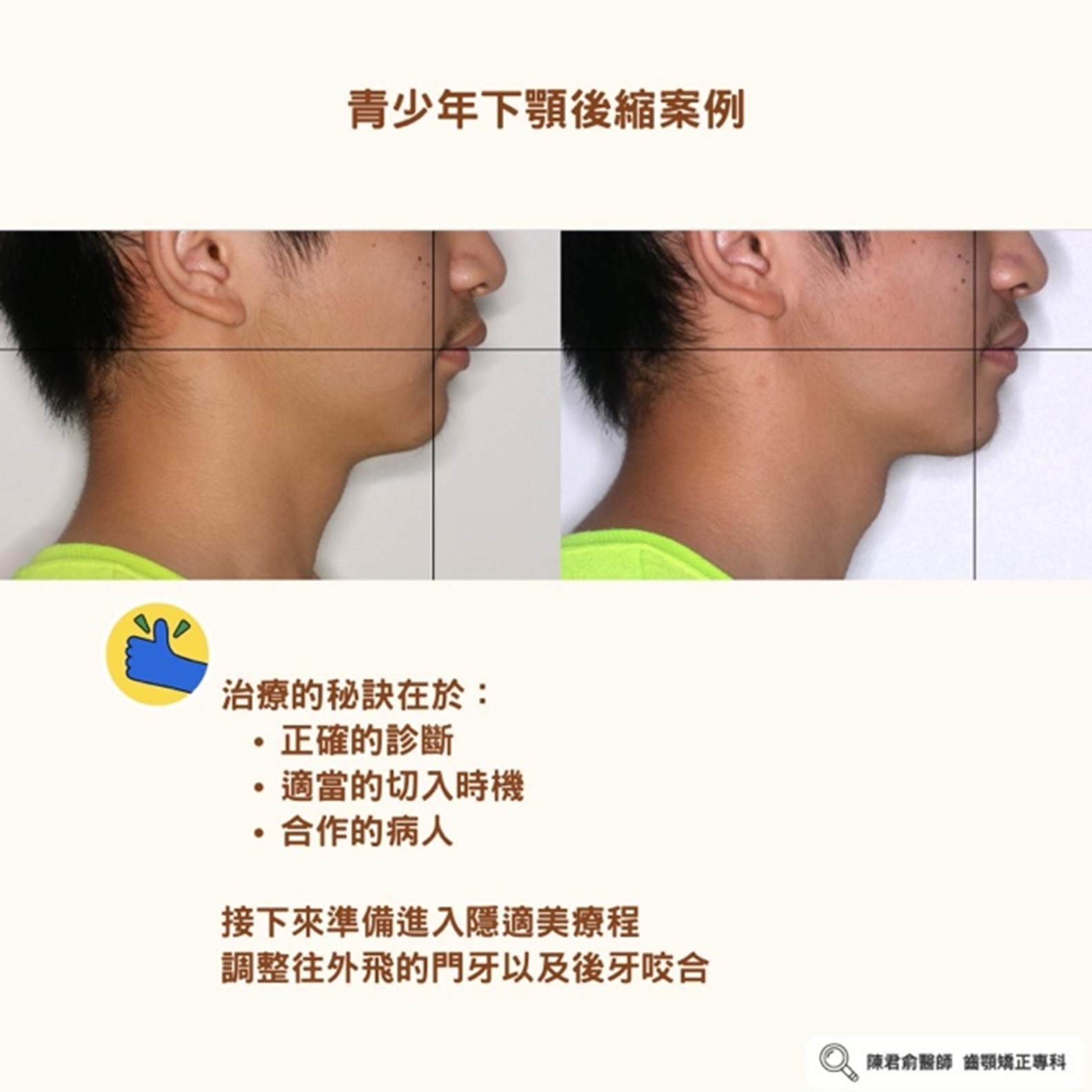 《青春期下顎後縮案例》 《青春期下顎後縮案例》