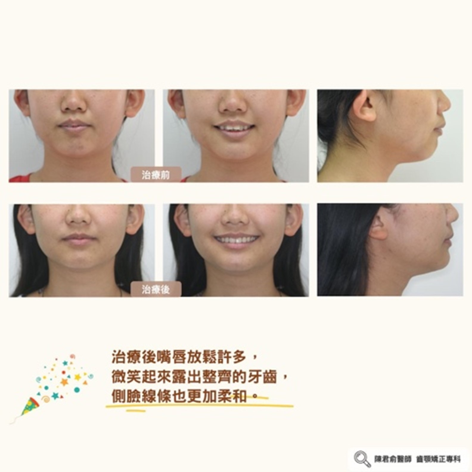 《齒性暴牙案例》 《齒性暴牙案例》
