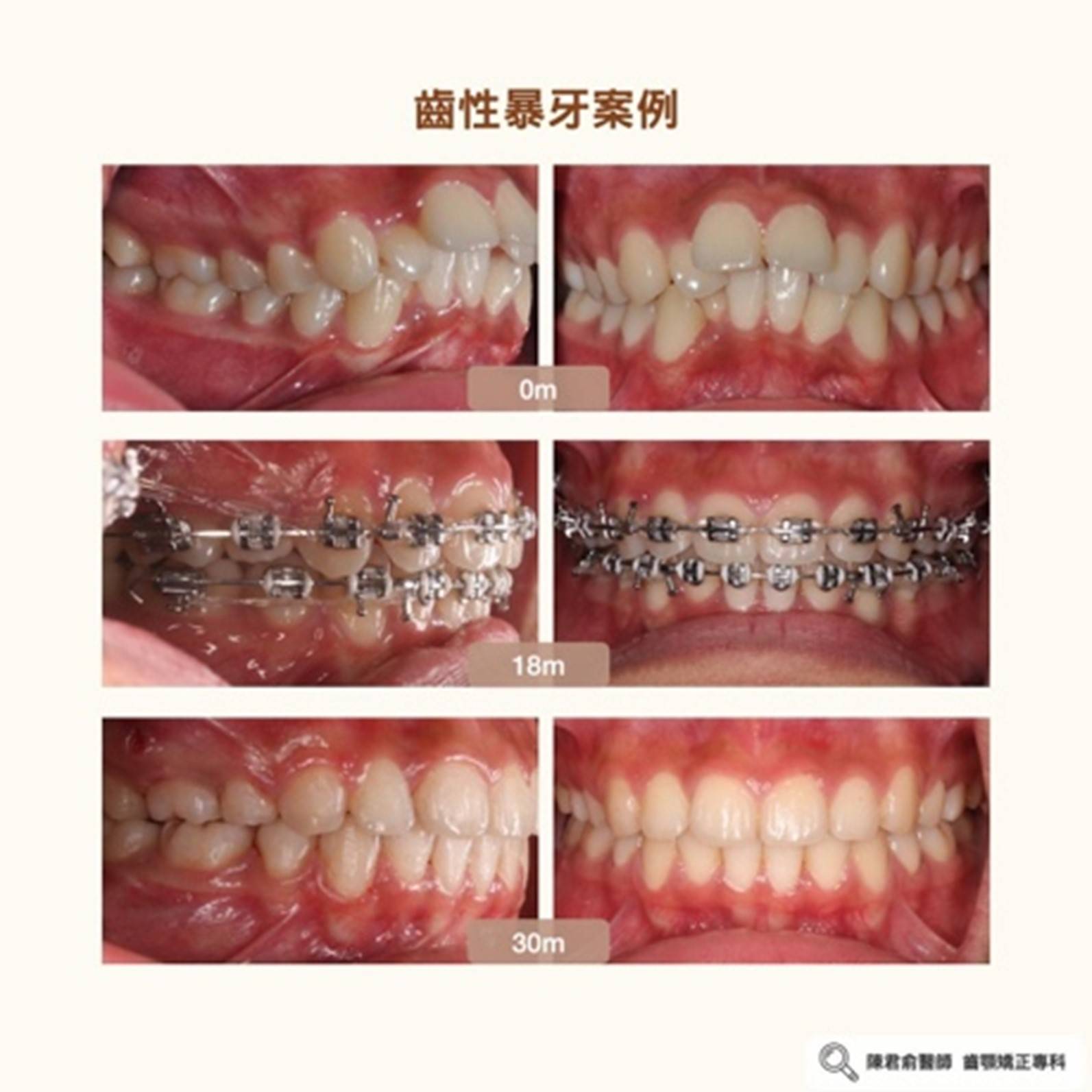 《齒性暴牙案例》 《齒性暴牙案例》