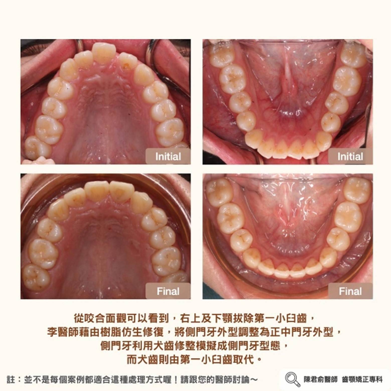 《協同治療案例:門牙缺牙--鄰牙取代,搭配型態修正》 《協同治療案例:門牙缺牙--鄰牙取代,搭配型態修正》