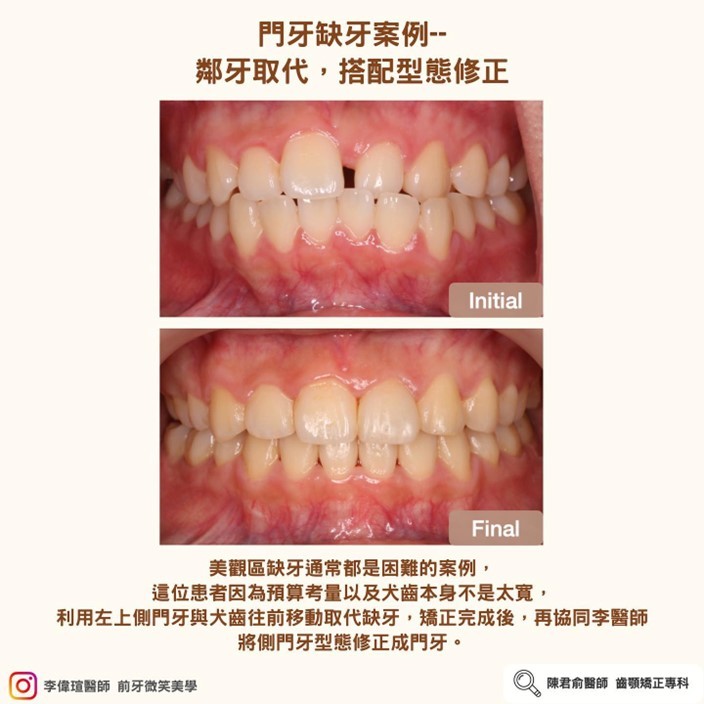 《協同治療案例:門牙缺牙--鄰牙取代,搭配型態修正》 《協同治療案例:門牙缺牙--鄰牙取代,搭配型態修正》