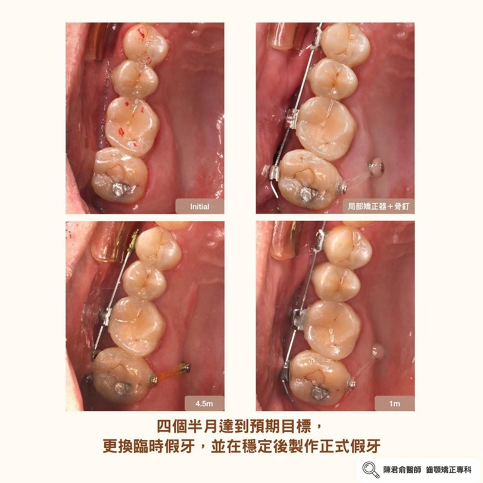 《協同案例:局部矯正--大臼齒壓入》 《協同案例:局部矯正--大臼齒壓入》