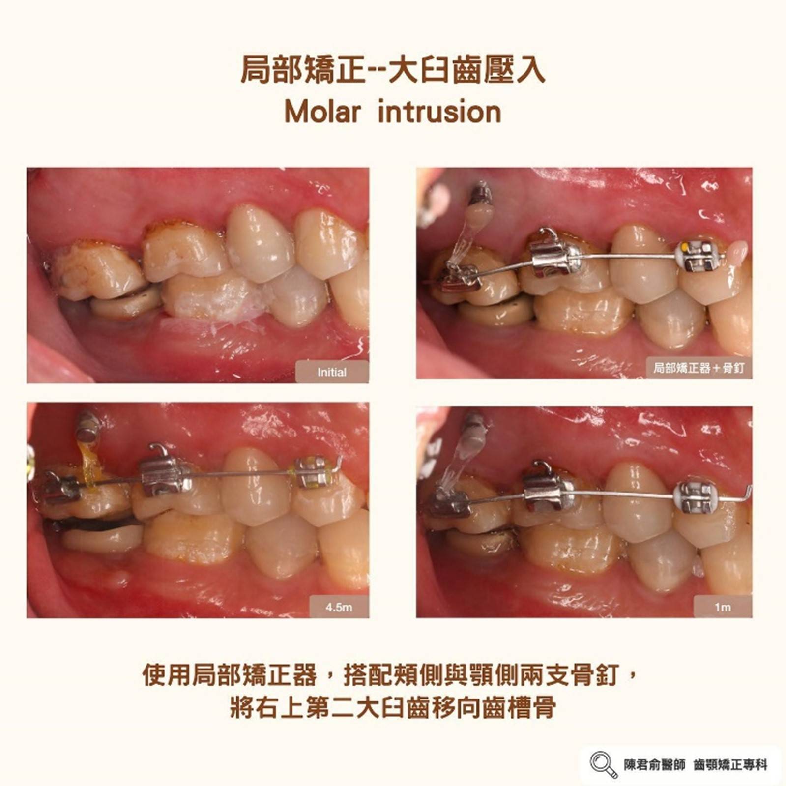 《協同案例:局部矯正--大臼齒壓入》 《協同案例:局部矯正--大臼齒壓入》