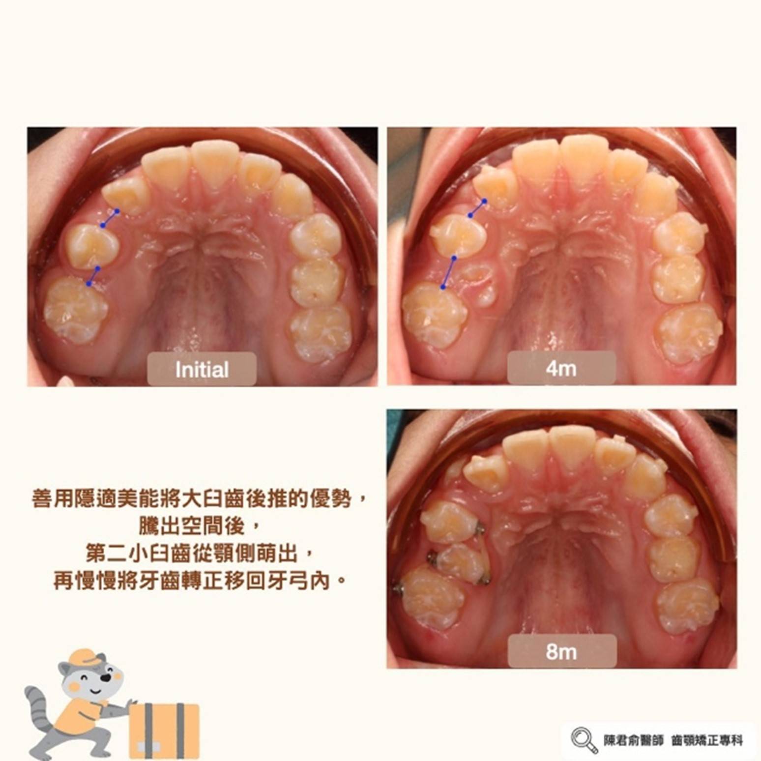《兒童口呼吸與深咬案例分享》 《兒童口呼吸與深咬案例分享》