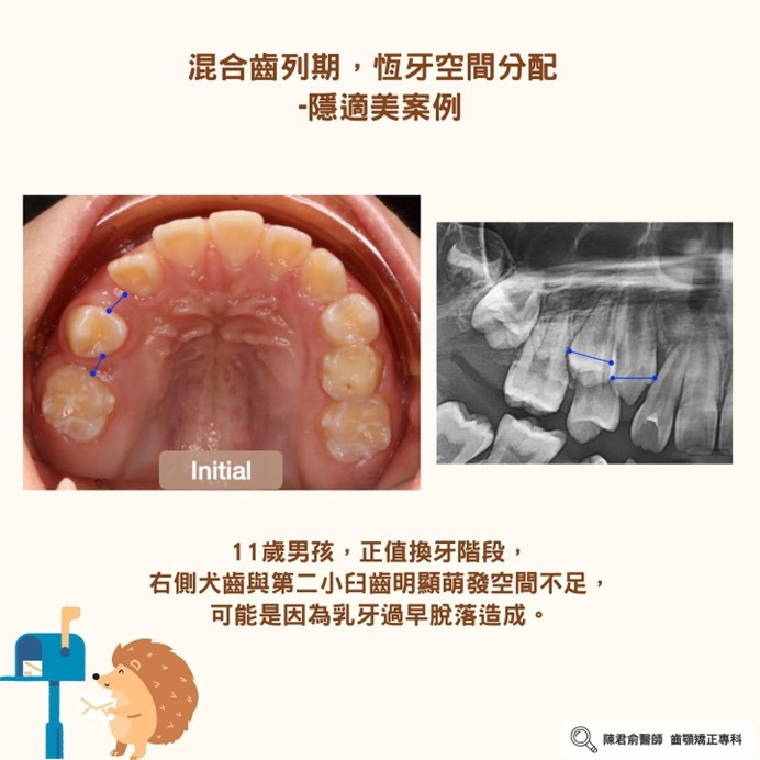 《兒童口呼吸與深咬案例分享》 《兒童口呼吸與深咬案例分享》