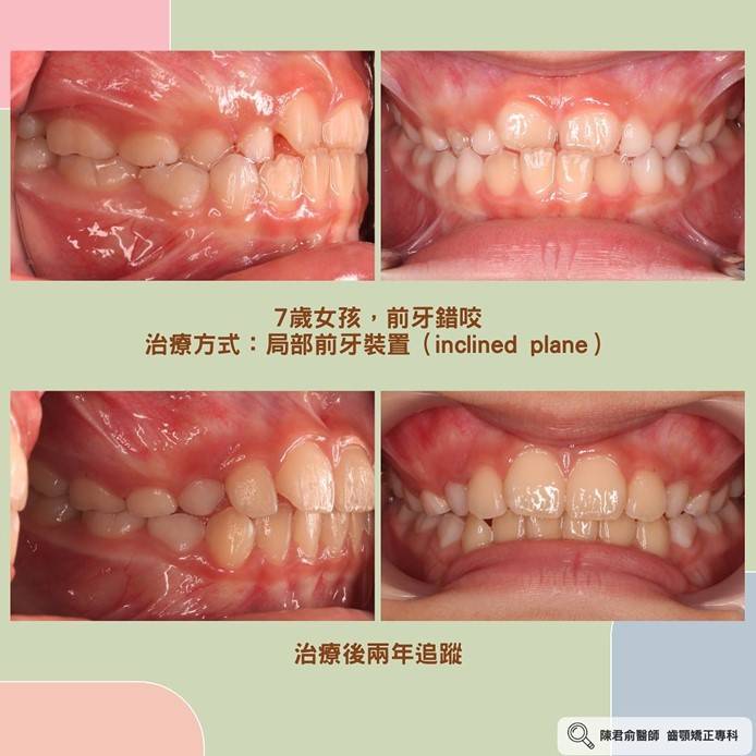 《前牙錯咬--成人與兒童案例分享》 《前牙錯咬--成人與兒童案例分享》