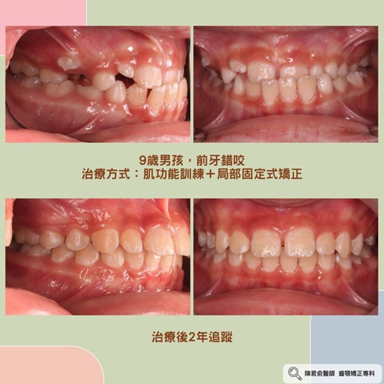 《前牙錯咬--成人與兒童案例分享》 《前牙錯咬--成人與兒童案例分享》