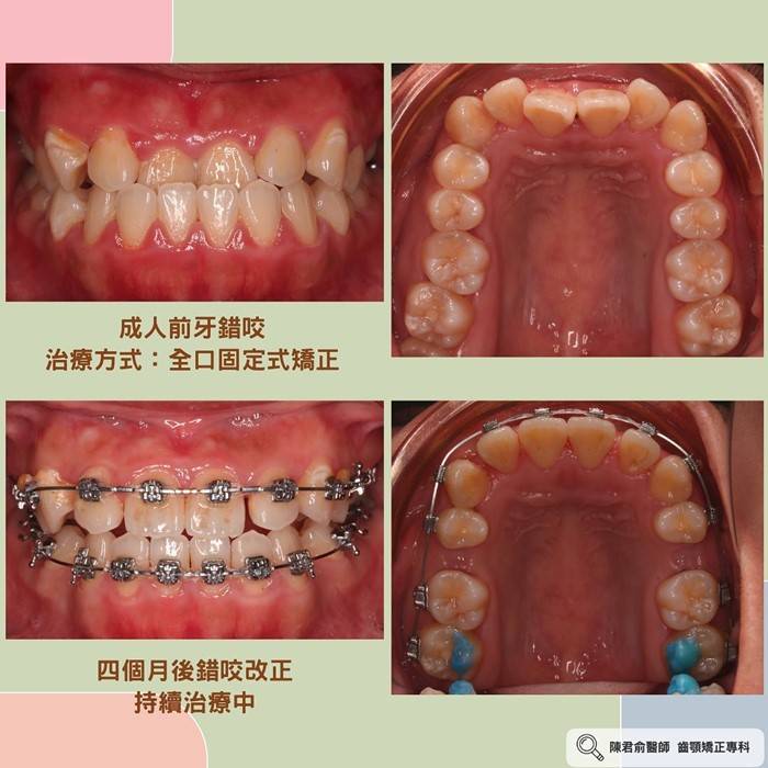 《前牙錯咬--成人與兒童案例分享》 《前牙錯咬--成人與兒童案例分享》